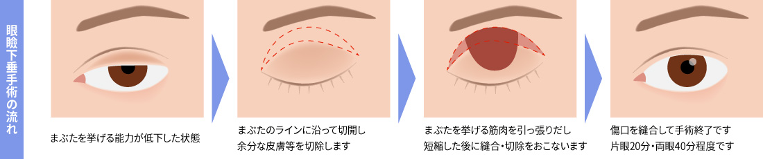 眼瞼下垂手術の流れ