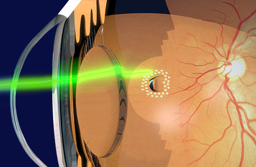 眼科レーザー治療